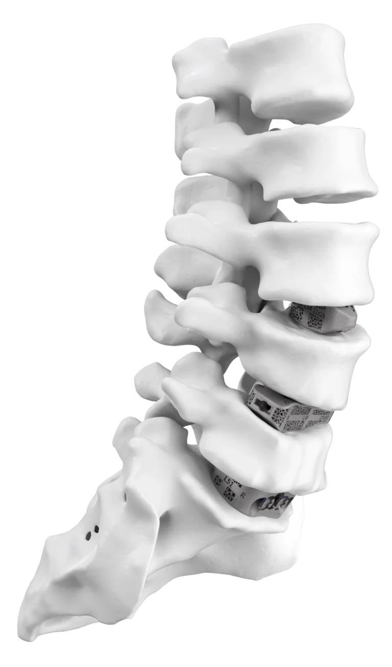 Multilevel SPINE NEW LLIF and OLIF posistion scaled 1 DgaUYQ