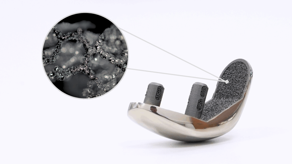 Partial Knee Implant with BiofuseE284A2 3D Printed Lattice Structure manufactured using Laser Powder Bed Fusion technology in Ti64 Grade 23 1024x576 RSGHny
