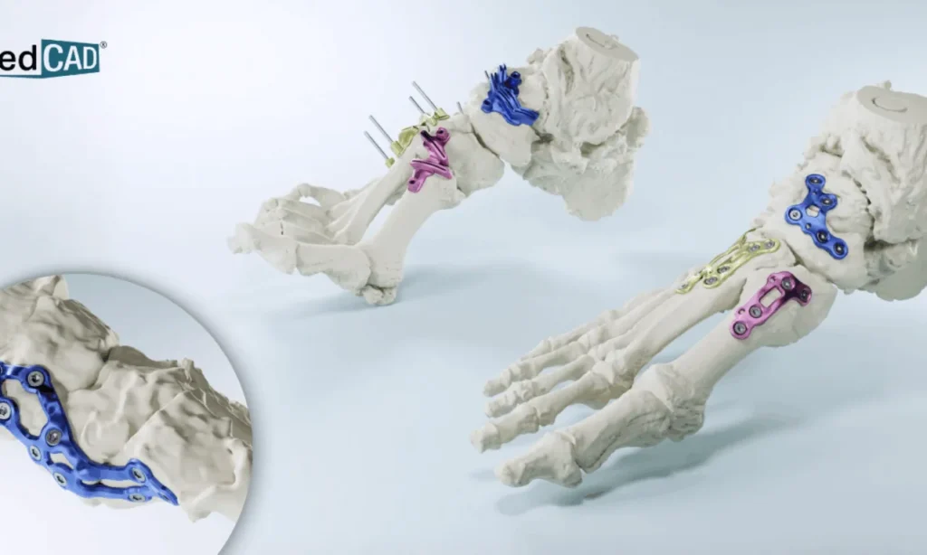 FDA Clears MedCAD’s 3D Printed Guides That Could Cut Surgery Time3DPrint.com | Additive Manufacturing Business 2 AccuStride Launch Graphic 1280768 c 1 jHHh5S